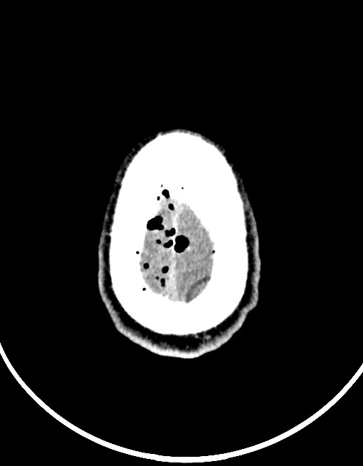 Arrow injury to the brain (Radiopaedia 72101-82607 Axial non-contrast 91).jpg
