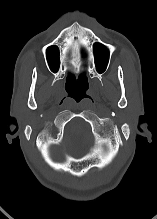 Arrow injury to the head (Radiopaedia 75266-86388 Axial bone window 42).jpg