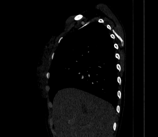 Arteria lusoria (Radiopaedia 88528-105192 C 31).jpg