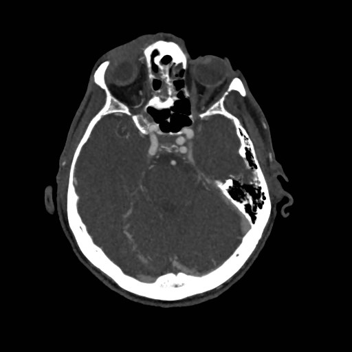 Artery of Percheron infarct (Radiopaedia 48088-52894 A 123).jpg