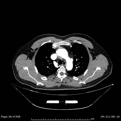 Ascending aortic aneurysm (Radiopaedia 50086-55404 A 12).jpg