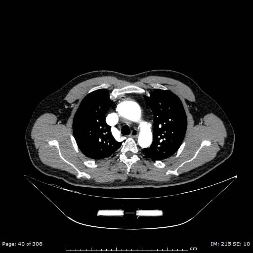 Ascending aortic aneurysm (Radiopaedia 50086-55404 A 14).jpg