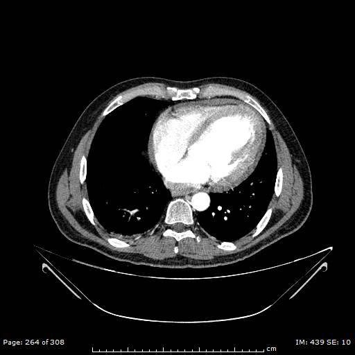 Ascending aortic aneurysm (Radiopaedia 50086-55404 A 68).jpg