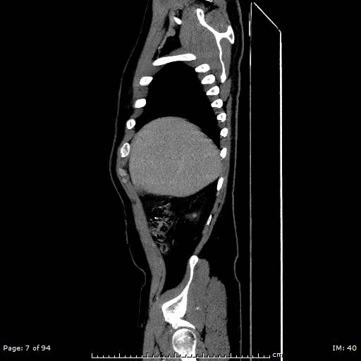 Ascending aortic aneurysm (Radiopaedia 50086-55404 C 5).jpg