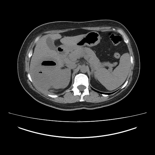 Ascending retrocecal appendicitis with liver abscesses (Radiopaedia 60066-67615 Axial non-contrast 26).jpg