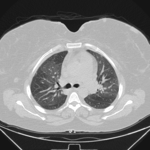 Aspergilloma (Radiopaedia 39611-41932 Axial lung window 47).jpg