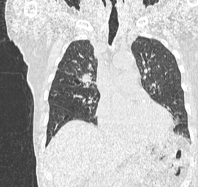 Aspergilloma (Radiopaedia 44592-48327 Coronal lung window 48).jpg
