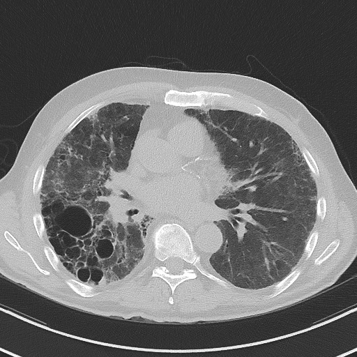Aspergilloma on background pulmonary fibrosis (Radiopaedia 60942-68757 A 31).jpg