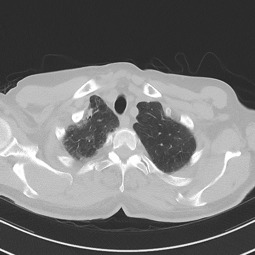 File:Aspergilloma on background pulmonary fibrosis (Radiopaedia 60942-68757 A 9).jpg