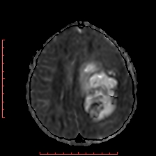Astroblastoma (Radiopaedia 74287-85162 Axial ADC 40).jpg