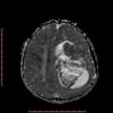 Astroblastoma (Radiopaedia 74287-85162 Axial ADC 48).jpg