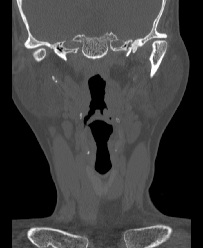 Atlanto-occipital assimilation with basilar invagination (Radiopaedia 70122-80188 Coronal bone window 12).jpg