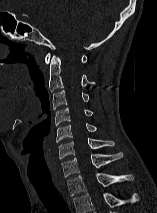 Atlantoaxial subluxation (Radiopaedia 44681-48450 Sagittal bone window 76).jpg