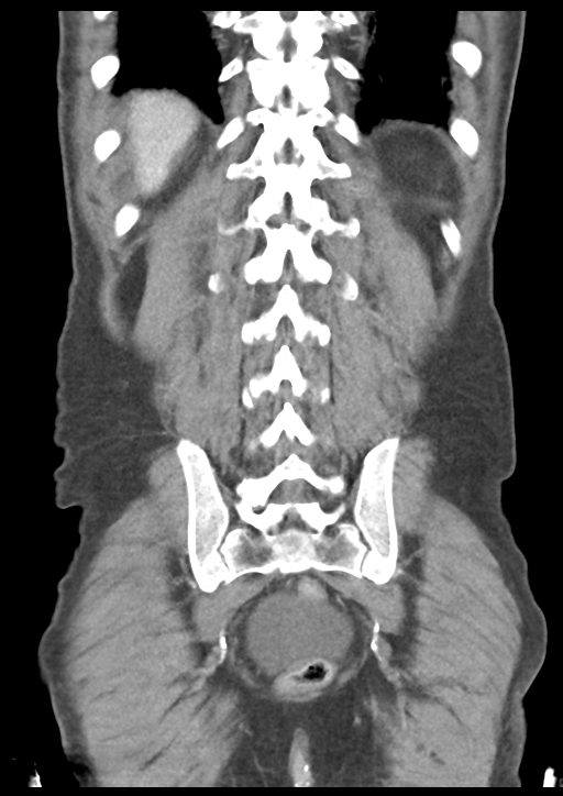 Atraumatic splenic rupture (Radiopaedia 42931-46160 B 48).png