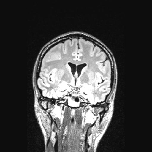 Atretic encephalocoele with inferior vermis hypoplasia (Radiopaedia 30443-31108 Coronal FLAIR 106).jpg