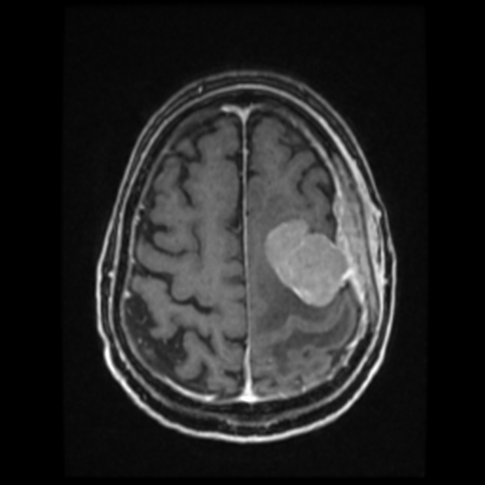 Atypical meningioma (Radiopaedia 45535-49629 Axial T1 C+ 53).jpg