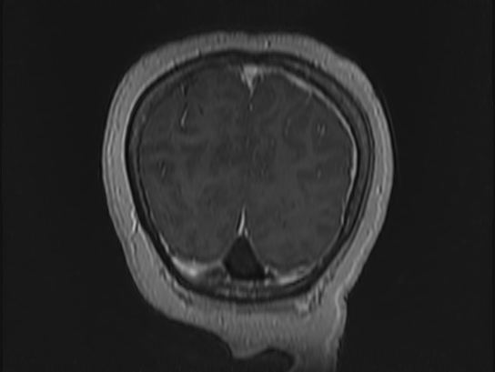 File:Atypical meningioma (Radiopaedia 62985-71406 Coronal T1 C+ 114).jpg