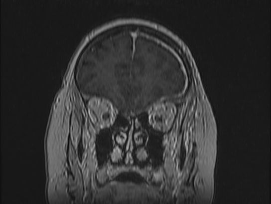 Atypical meningioma (Radiopaedia 62985-71406 Coronal T1 C+ 22).jpg