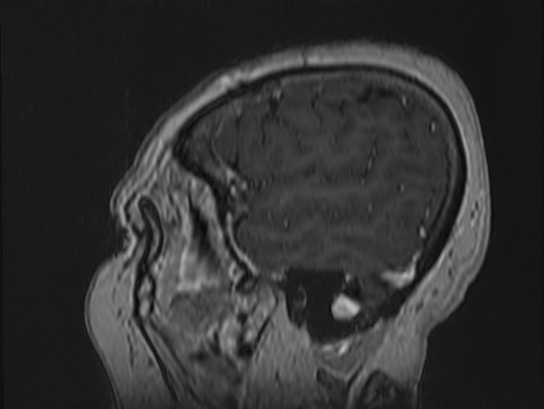 Atypical meningioma (Radiopaedia 62985-71406 Sagittal T1 C+ 8).jpg
