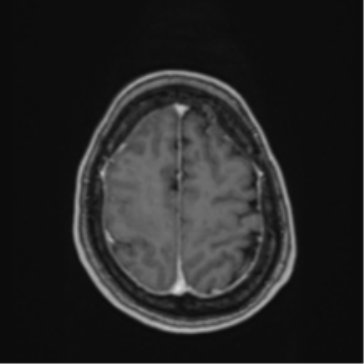 Atypical meningioma (WHO Grade II) (Radiopaedia 54742-60979 Axial T1 C+ 55).png