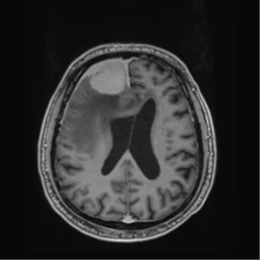 File:Atypical meningioma (WHO grade II) with brain invasion (Radiopaedia 57767-64729 Axial T1 C+ 31).png