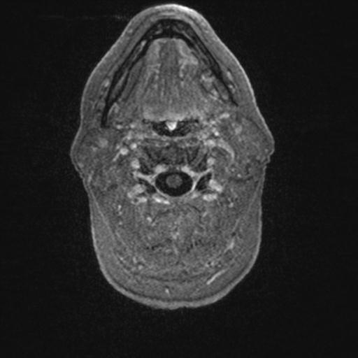 Atypical meningioma (grade II) - en plaque (Radiopaedia 29633-30147 Axial T1 C+ 10).jpg