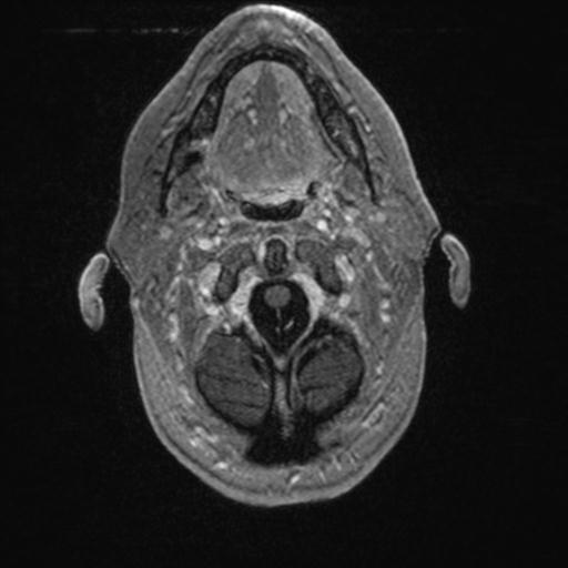 Atypical meningioma (grade II) - en plaque (Radiopaedia 29633-30147 Axial T1 C+ 19).jpg