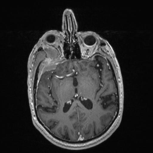 Atypical meningioma (grade II) - en plaque (Radiopaedia 29633-30147 Axial T1 C+ 98).jpg