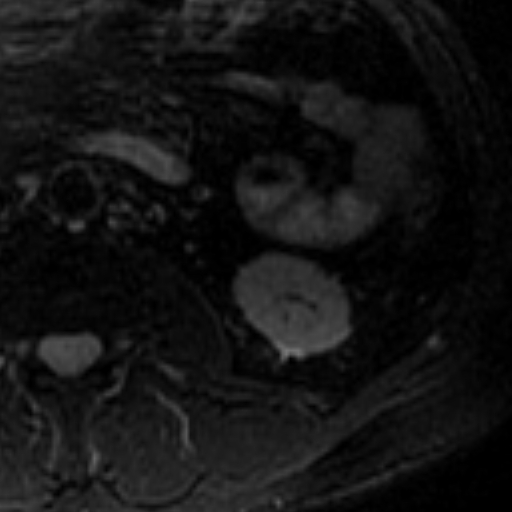 File:Atypical renal cyst on MRI (Radiopaedia 17349-17046 Axial T2 fat sat 19).jpg