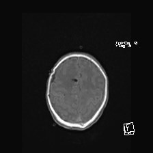 Atypical teratoid rhabdoid tumor (prenatal US and neonatal MRI) (Radiopaedia 59091-66388 Axial T1 47).jpg