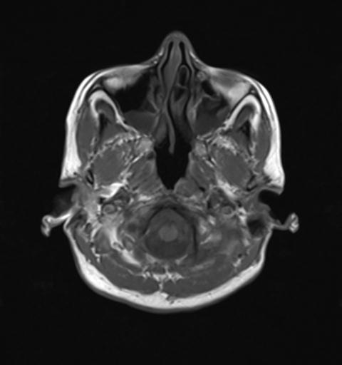 File:Autoimmune limbic encephalitis (Radiopaedia 30363-31005 Axial T1 4).jpg