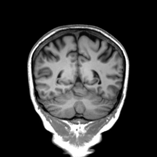 Autoimmune limbic encephalitis (Radiopaedia 30363-31005 Coronal T1 18).jpg