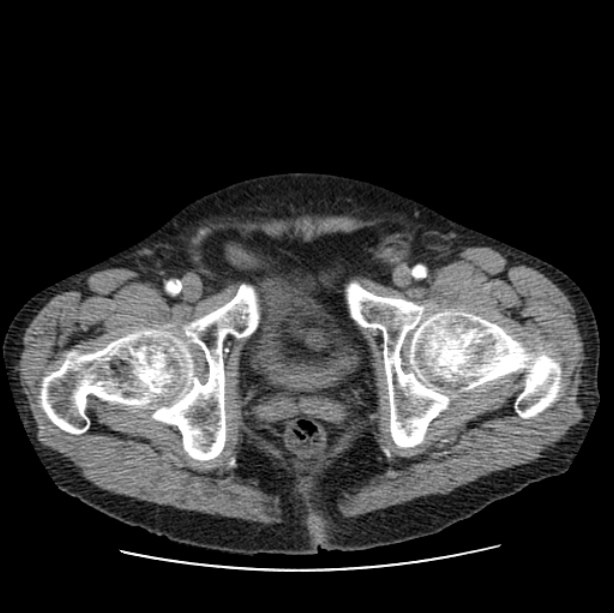 Autosomal dominant polycystic kidney disease (Radiopaedia 27851-28094 B 118).jpg