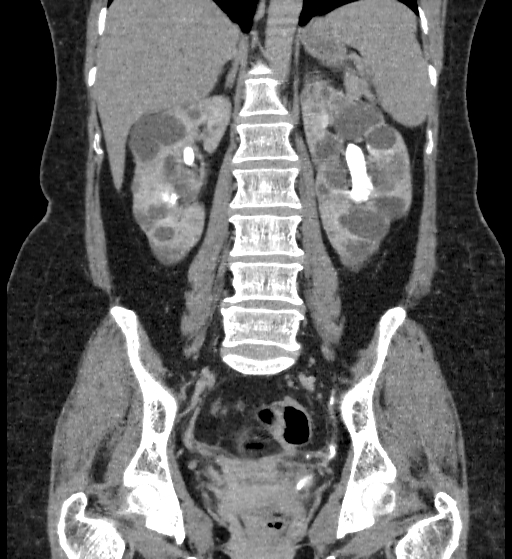 File:Autosomal dominant polycystic kidney disease (Radiopaedia 38189-40194 Coronal C+ delayed 63).jpg
