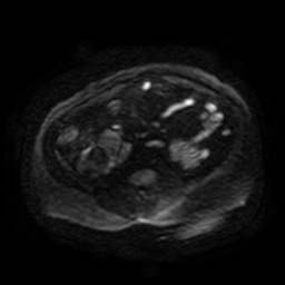 Autosomal dominant polycystic kidney disease (Radiopaedia 50259-55611 Axial DWI 104).jpg
