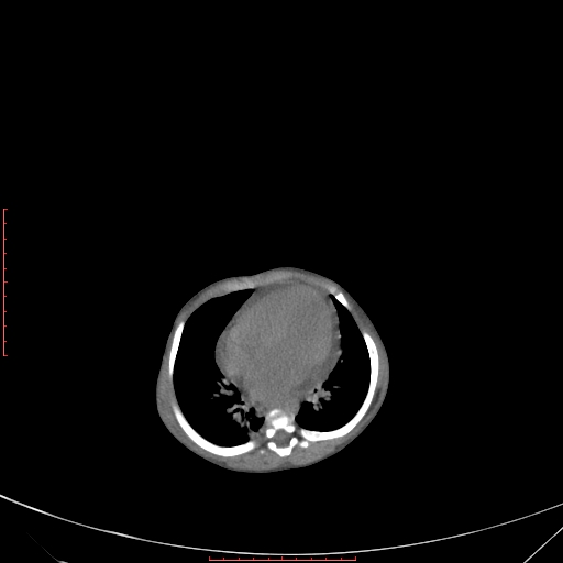 File:Autosomal recessive polycystic kidney disease associated with Caroli disease (Radiopaedia 61932-69984 Axial non-contrast 75).jpg