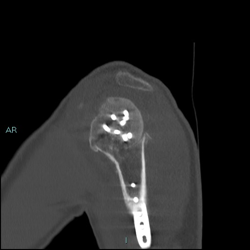 Avascular necrosis after fracture dislocations of the proximal humerus (Radiopaedia 88078-104653 Sagittal bone window 22).jpg
