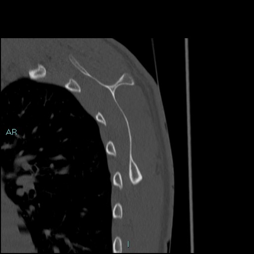 Avascular necrosis after fracture dislocations of the proximal humerus (Radiopaedia 88078-104653 Sagittal bone window 68).jpg