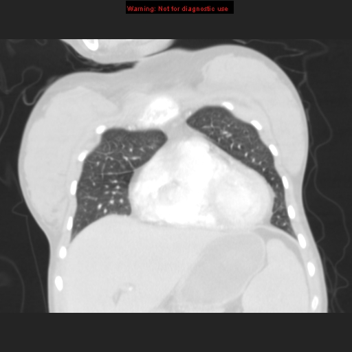 File:Avascular necrosis in sickle cell disease (Radiopaedia 17448-17152 B 33).jpg