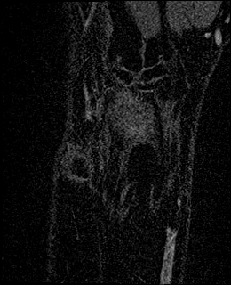 Avascular necrosis of the capitate (Radiopaedia 88317-104948 Coronal T1 vibe 11).jpg