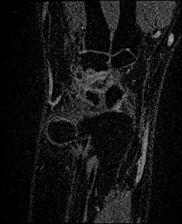 Avascular necrosis of the capitate (Radiopaedia 88317-104948 Coronal T1 vibe 17).jpg