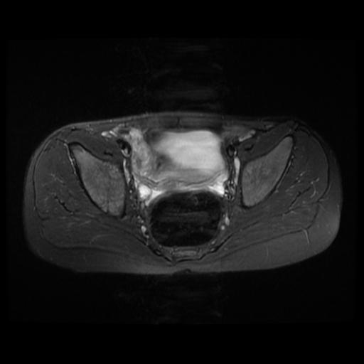 File:Avascular necrosis of the hip (Radiopaedia 29563-30067 Axial T2 fat sat 1).jpg