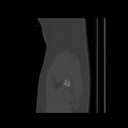 Avascular necrosis of the hip (Radiopaedia 61503-69467 B 61).jpg