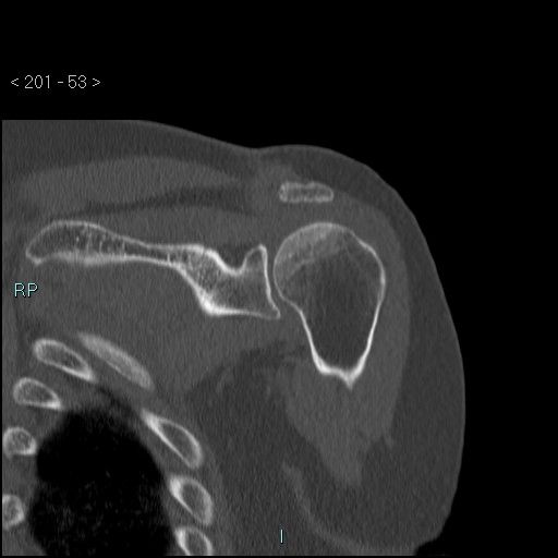 Avascular necrosis of the shoulder - Cruess stage I (Radiopaedia 77674-89887 Coronal bone window 52).jpg