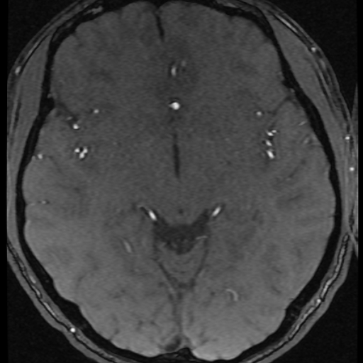 Azygos anterior cerebral artery (Radiopaedia 17059-16756 Axial MRA 27).jpg