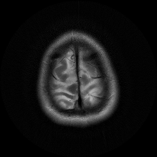 File:Azygos anterior cerebral artery (Radiopaedia 17059-16756 Axial T2 2).jpg