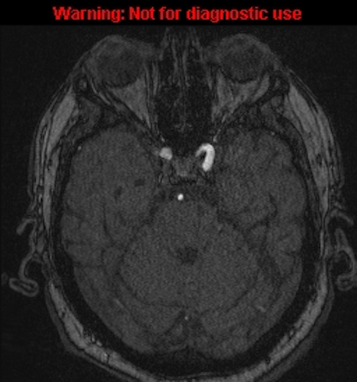 Azygos anterior cerebral artery (Radiopaedia 59325-66677 Axial MRA 49).jpg