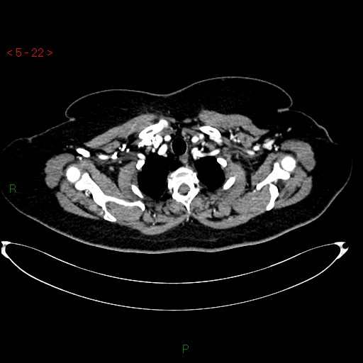 File:Azygos fissure and lobe (Radiopaedia 47620-52278 A 8).jpg