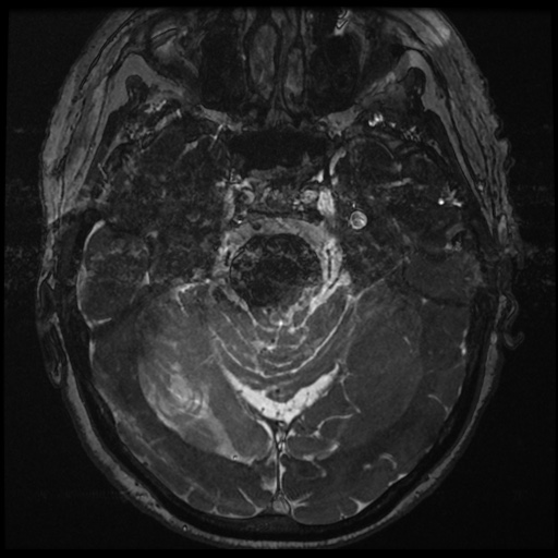 File:Balo concentric sclerosis (Radiopaedia 53875-59982 Axial T2 FIESTA 64).jpg