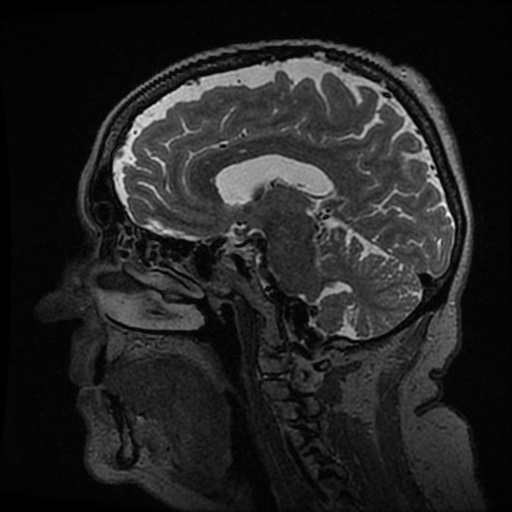 Balo concentric sclerosis (Radiopaedia 53875-59982 Sagittal 3D FSE 126).jpg